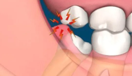 Gencives dent de sagesses