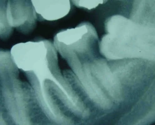 Chirurgie dents de sagesse